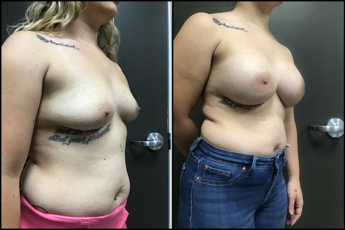 Breast Augmentation Before and After Photos Freed Plastic Surgery