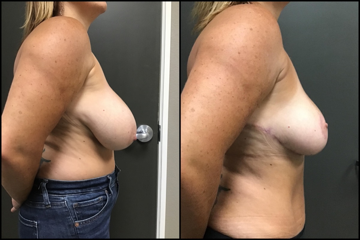 Breast Reduction Before & After Photos